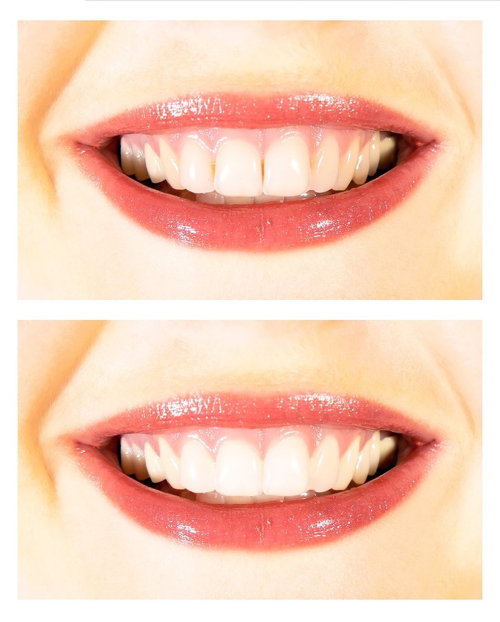 before and after photo of mouth after Cosmetic Dentistry North Syracuse, NY